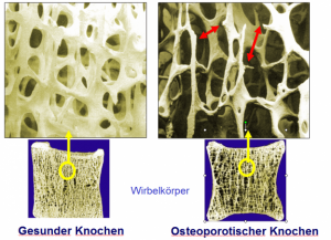 Osteoporose - Bild gesunder Knochen & osteoporotischer Knochen im Vergleich